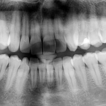 Radiographie dentaire