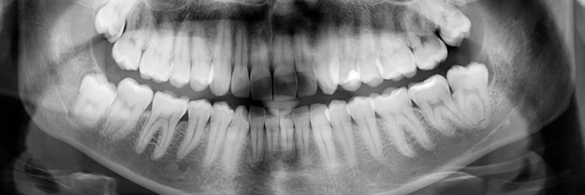 Qu’est-ce qu’une radiographie dentaire ? À quoi sert-elle ?