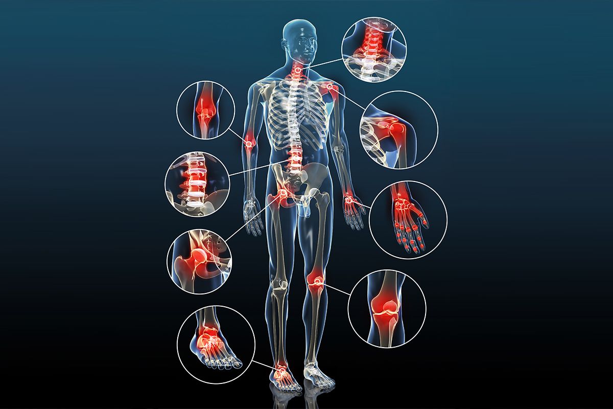 Évitez ces 3 erreurs courantes pour prévenir l’arthrose !