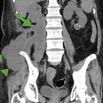 abcès du psoas symptômes,abcès du psoas risques