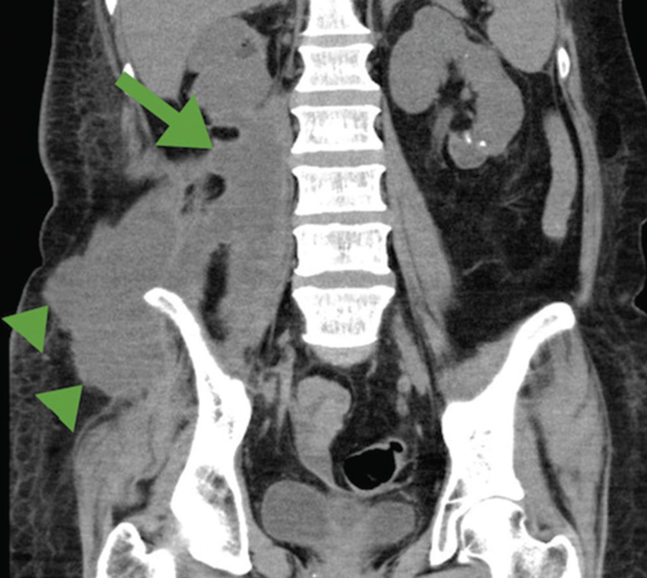 Abcès du psoas : symptômes et risques