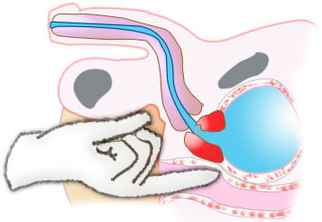 Cancer de la prostate : pathologie 3D et apprentissage profond